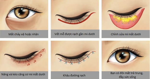 phẫu thuật midface mi dưới tại tmv Nguyễn Thế Thạnh