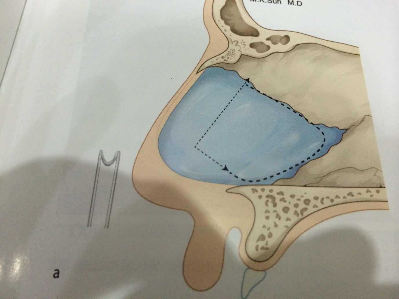 Nâng mũi s-line cấu trúc