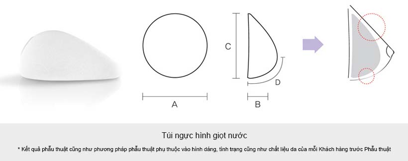 Túi nâng ngực giọt nước - thẩm mỹ viện bác sĩ Nguyễn Thế Thạnh