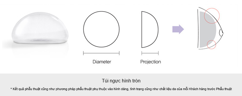 Túi nâng ngực tròn - thẩm mỹ viện bác sĩ Nguyễn Thế Thạnh